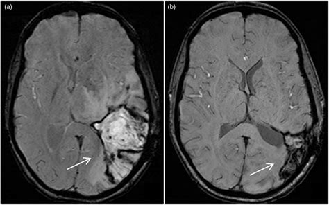 Intraparenchymal Hemorrhage Mri