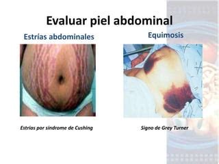 Exploracion gastro semiologia abdomen | PPT