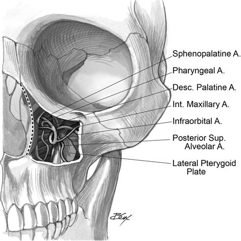 Midface degloving approach to the skull base - Operative Techniques in Otolaryngology-Head and ...