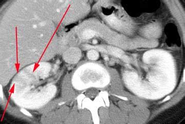 Genitourinary Radiology > Kidneys > Parenchymal > Large Kidney > Pyelonephritis