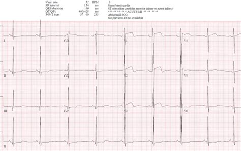 Wellens' syndrome, reperfusion and reocclusion MI | ECG Cases | EM Cases