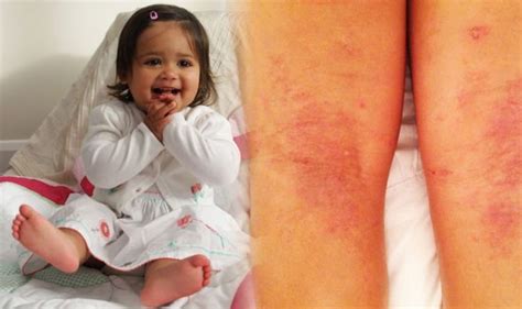 Eczema treatment: Parents invent own ‘miracle’ cream to cure daughter’s ...