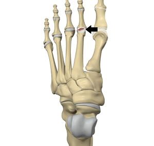 Freiberg's Disease | Advanced Orthopaedics & Sports Medicine ...