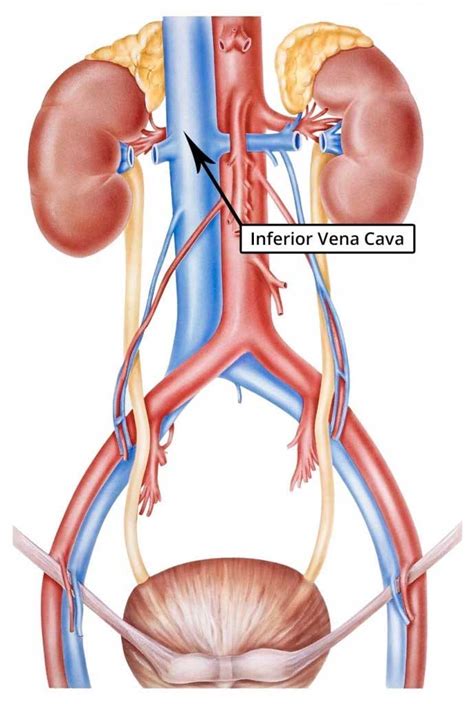 IVC Filter Complications - Movement, Vein Puncture and Blockage