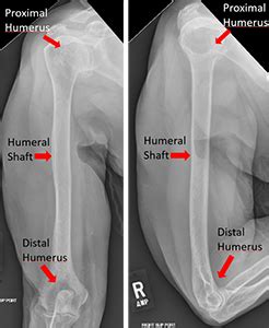 X Ray Shows Fracture Of The Humeral Head And Intrarotation Of The Arm ...