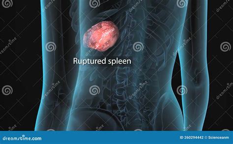 A Ruptured Spleen is a Medical Emergency that Occurs As a Result of a Break in Your Spleen S ...