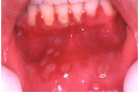 Herpes Simplex Virus (Hsv) Infection Of The Mouth – European ...