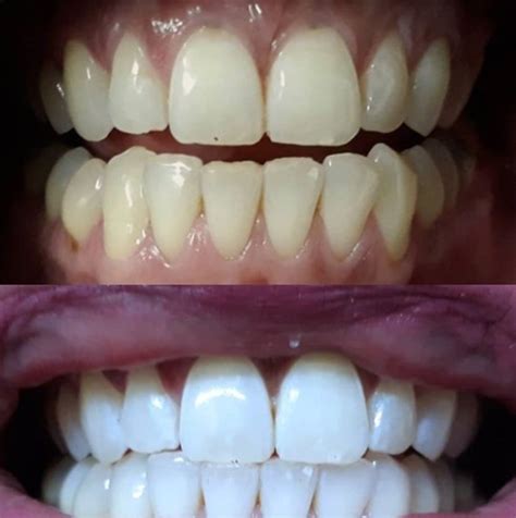 Snow Teeth Whitening Reviews (Before/After Photos)