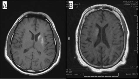 Brain MRI T1-weighted axial images representing basal ganglia lesions ...