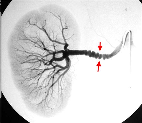 Fibromuscular Dysplasia - Causes, Symptoms, Diagnosis & Treatment