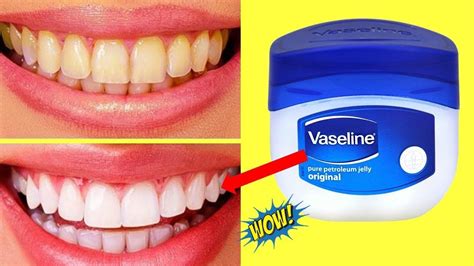 Does Vaseline Make Your Teeth White - Teeth Poster