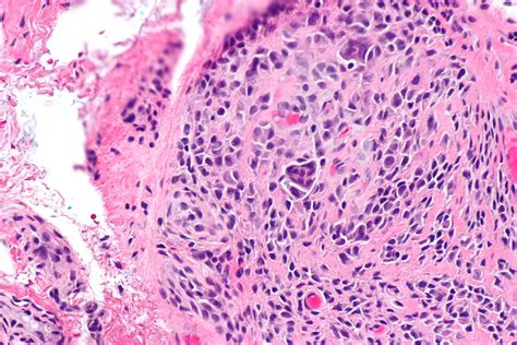 Giant Cell Tumor Histology