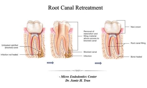 Root Canal Retreatment - Micro Endodontics Center