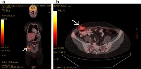 a & b: FDG-PET scan coronal and transverse cuts showing FDG avid uptake ...