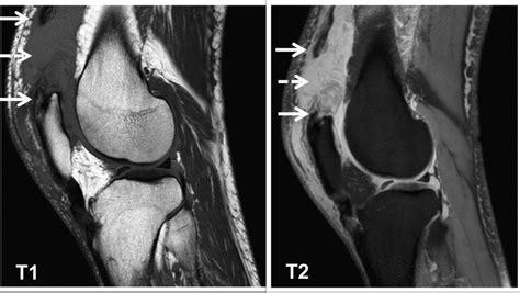 MRI features of a quadriceps tendon rupture | BMJ Case Reports