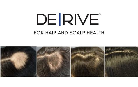 DE|RIVE hair regeneration treatment in Greenville, SC | RMI