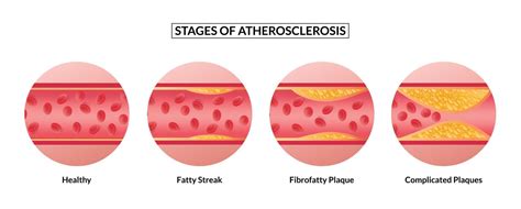 stages of atherosclerosis. Atherosclerosis formation Healthy artery and unhealthy arteries ...