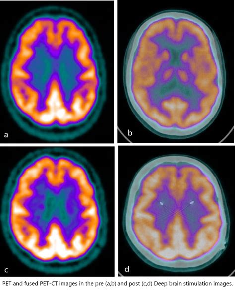 Brain Scan Depression