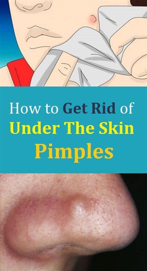 How to Get Rid of Under The Skin Pimples | Blind pimple, Painful pimple ...