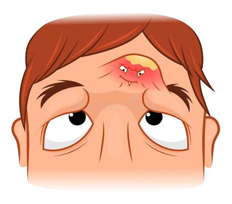 Pimple on the forehead stock vector. Illustration of biology - 129641985