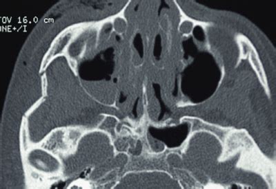 Facial Trauma Surgery - North Shore Oral Maxillofacial Surgery