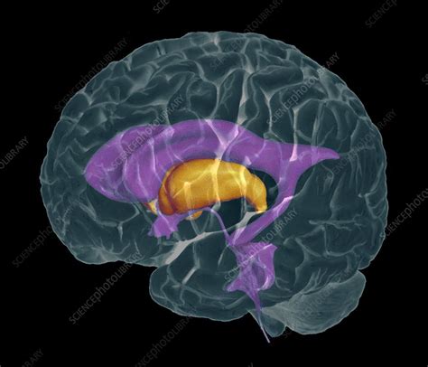 Brain ventricles, coloured CT/MRI scan - Stock Image - P330/0333 - Science Photo Library