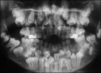 ScienceDirect.com - American Journal of Orthodontics and Dentofacial Orthopedics - Multiple ...