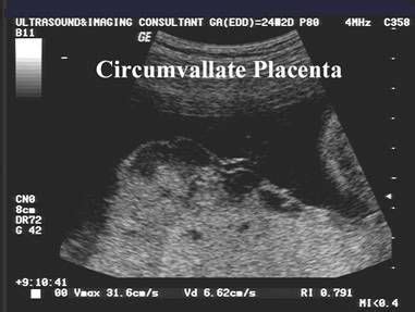 Ultrasound of Circumvallate Placenta | Ultrasound, Ultrasound ...