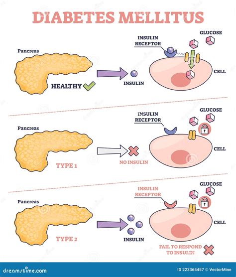 Pancreas Diabetes Diagram