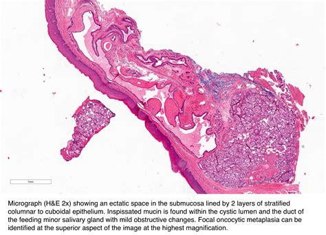 Mucous Retention Cyst Lip Pathology Outlines | Sitelip.org