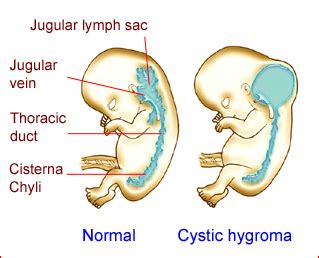 Cystic Hygroma – Department of Obstetrics and Gynecology Faculty of Medicine Chiang Mai University