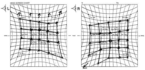 Skew deviation as a complication of cardiac catheterization - American Journal of Ophthalmology