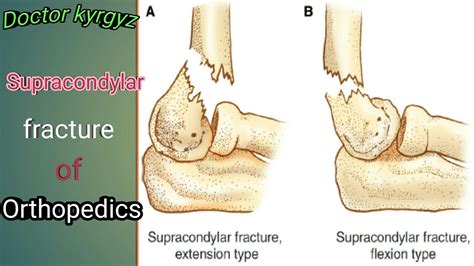 Supracondylar fracture, classification, C. Features, treatment and ...