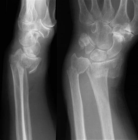 Smith fracture • LITFL • Medical Eponym Library