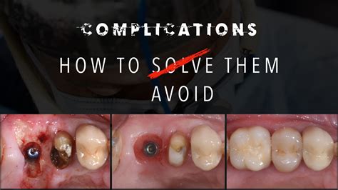 Complications in Implant Dentistry. How to solve them and how to avoid ...