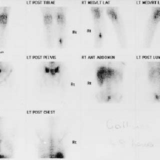 Hectic fever pattern prior to diagnosis. | Download Scientific Diagram