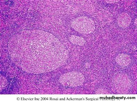 Pathology of lymph node pptx - D. Hameed - Muhadharaty