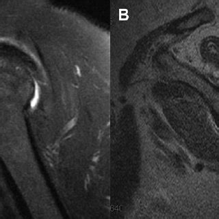 Coracohumeral ligament extensions. The coracohumeral ligament ( orange... | Download Scientific ...