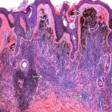 Congenital Melanocytic Nevus Histology