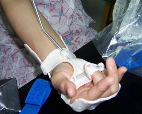 Dorsal Blocking Orthosis for Flexor Tendon Rehabilitation