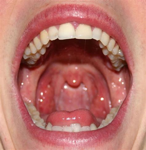 Pharyngitis, Causes, Symptoms, Diagnosis, Treatment - Rxharun