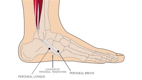 Peroneus Longus Pain