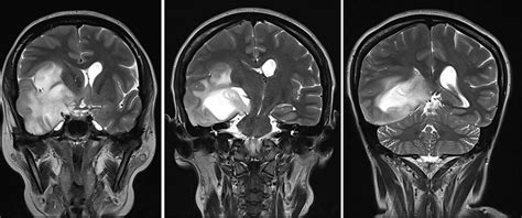 Diffuse astrocytoma – Radiology Cases