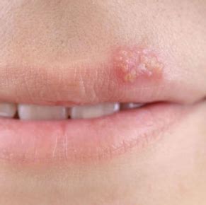 What Does The Start Of Herpes On Lips Look Like | Lipstutorial.org