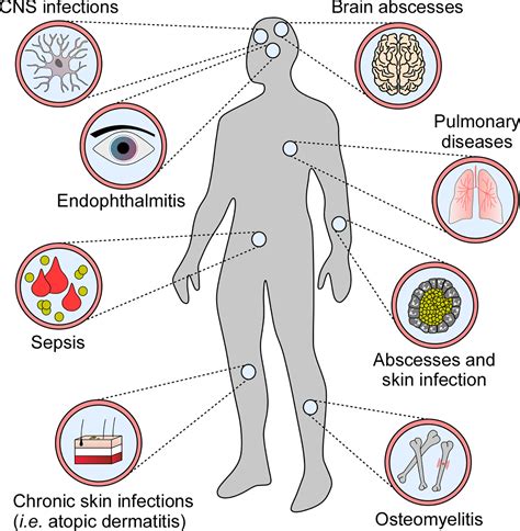 Pathogenesis Of Staphylococcus Aureus