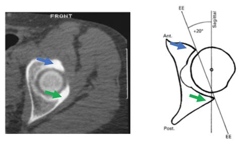 Acetabular Retroversion | David Slattery Orthopaedic Surgeon