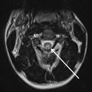 Axial T2 MRI cervical spine. Arrow: bilateral highintensity T2 signal ...