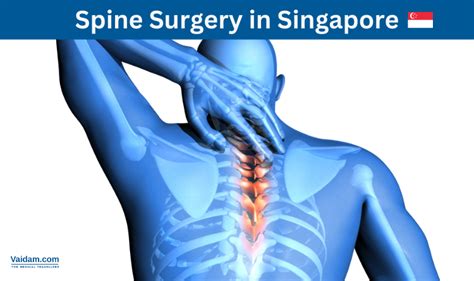 Spine Surgery in Singapore | Vaidam Health