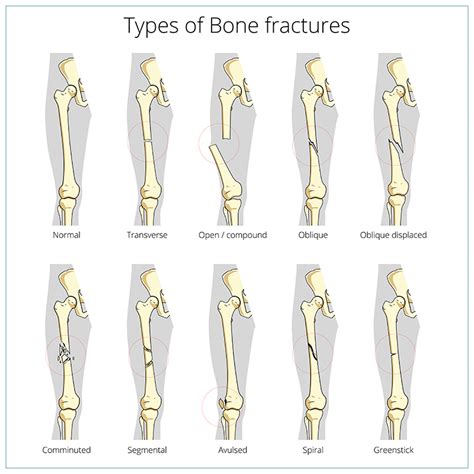 Fractures (Broken Bone) | Fremont Orthopedic & Rehabilitation Medicine