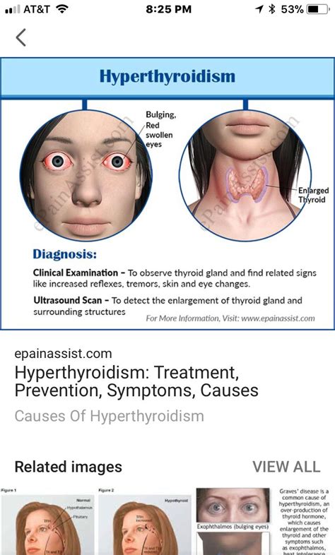 Pinterest | Thyroid, Enlarged thyroid, Thyroid medicine